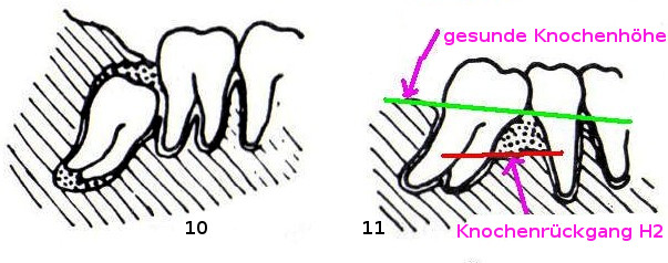 10 – Dentitio difficilis = erschwerter Durchbruch eines Zahnes, oft wie hier bei Weisheitszähnen. 11 – parodontale Taschenbildung durch Winkelstellung der Zähne (frühzeitige Entfernung des ersten Molaren mit Kippung des hinteren Zahnes)