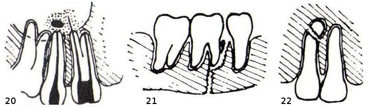 20 – links: überstopftes Wurzelfüllmaterial in der Kieferhöhle, rechts: Metallstift als Wurzelfüllung mit Entzündungszone. 21 – gebrochener Unterkiefer mit Zahn im Bruchspalt. 22 – Zahn mit Bruch an der Wurzelspitze