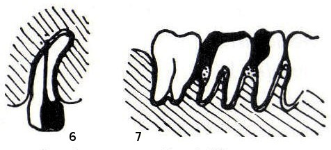 6 – Wurzelkanalperforation bei abgekrümmter Wurzelspitze, Restkanalinhalt infiziert. 7 – überstehende Füllungen mit parodontalem Knochenabbau